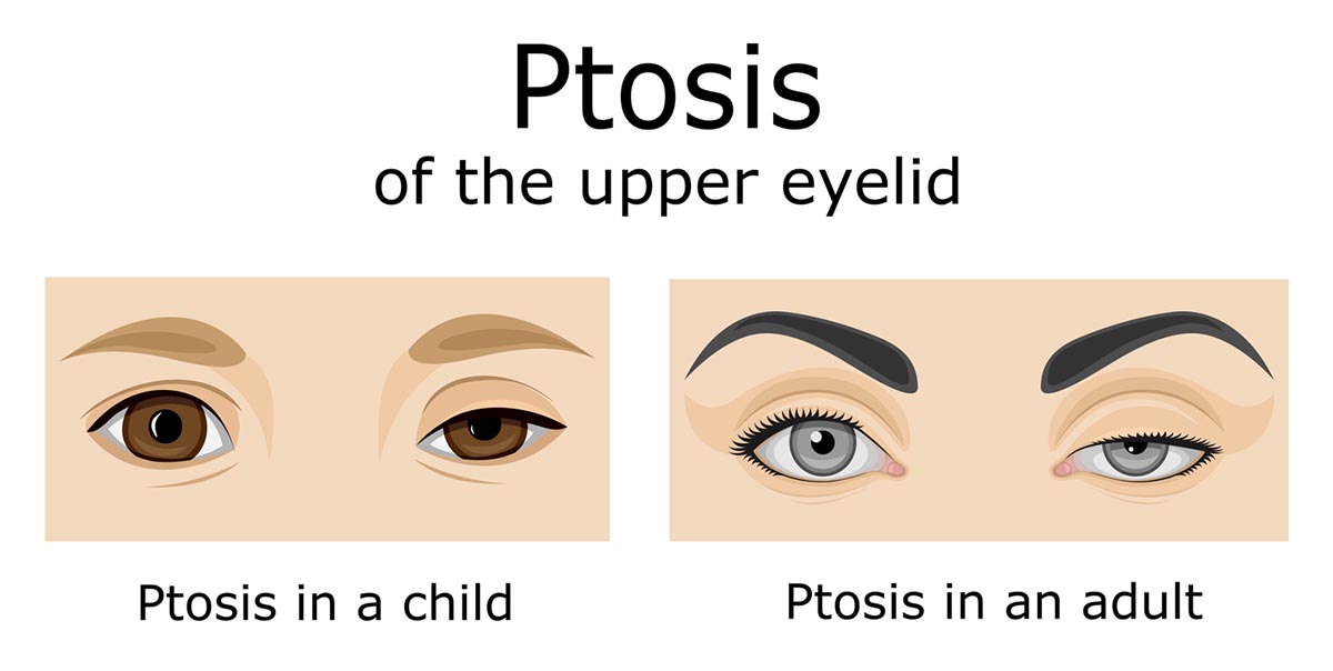 Ptosis Surgery, Singapore: How Much Does Ptosis Surgery Cost?